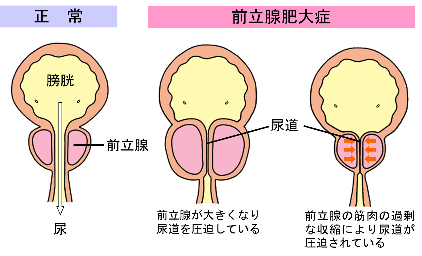 前立腺 肥大 と psa